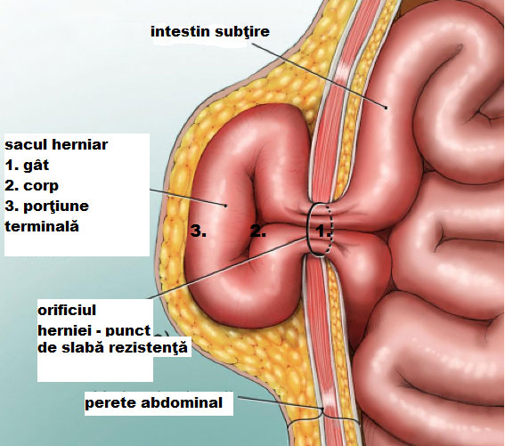 hernia-abdominala-bogdan-smeu