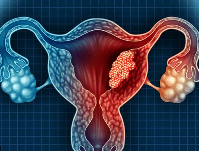 Cancer de col uterin