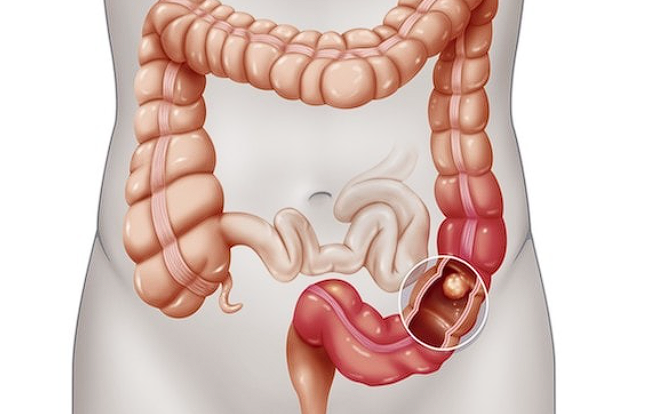 Chirurgie Colorectala Laparoscopică