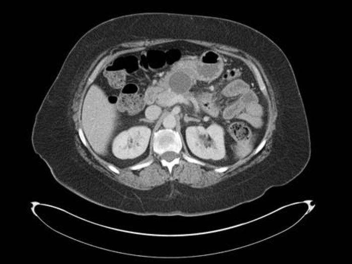 Chist Pancreatic