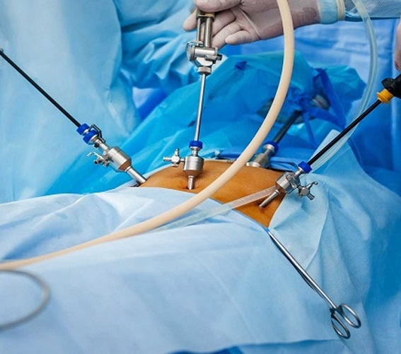 Cura laparoscopică a herniei ombilicale - dr-bogdan-smeu