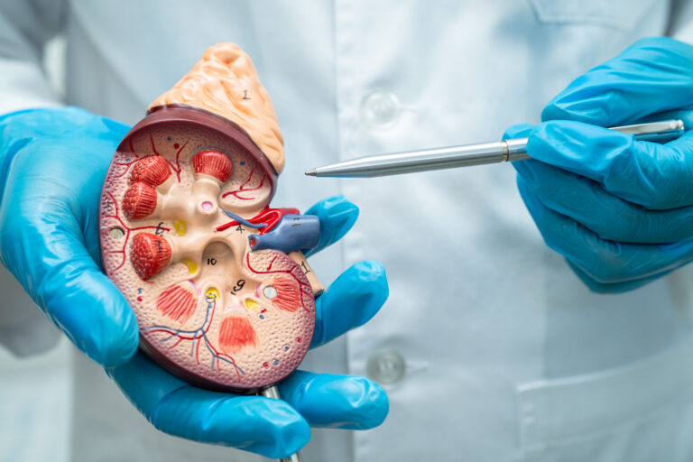 Kidney disease, Chronic kidney disease ckd, Doctor hold model to
