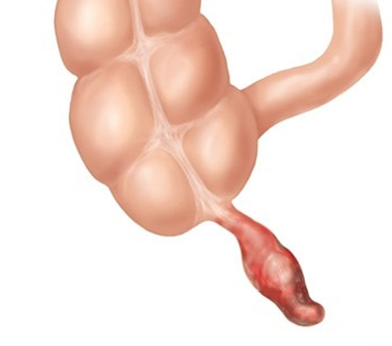 apendicita-dr-bogdan-smeu