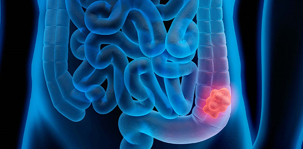 cancer colon