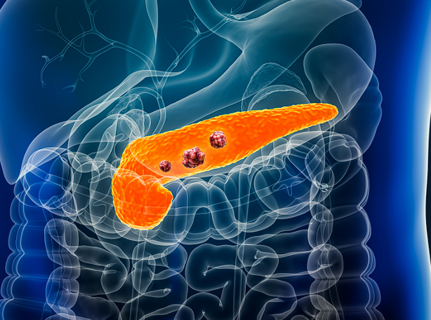 cancer pancreatic