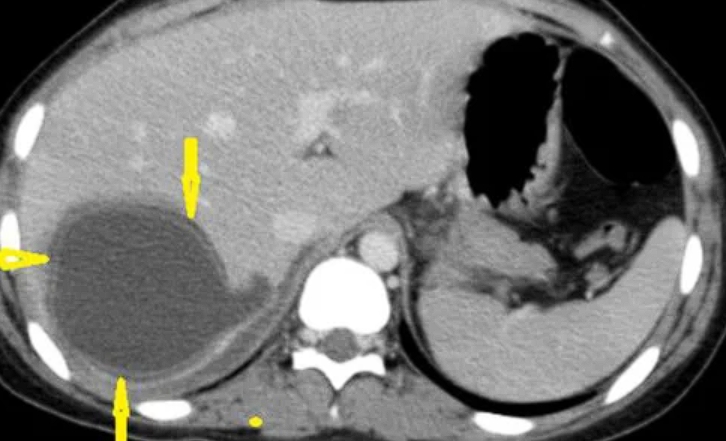 chistul hidatic hepatic