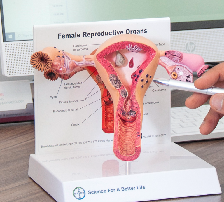 endometrioza