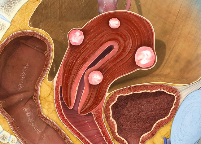fibrom uterin