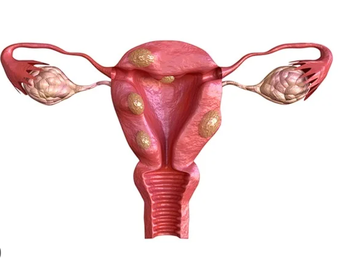 fibromatoza uterina