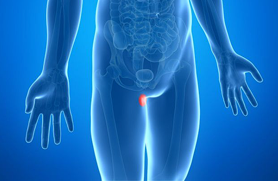 hernia femurala