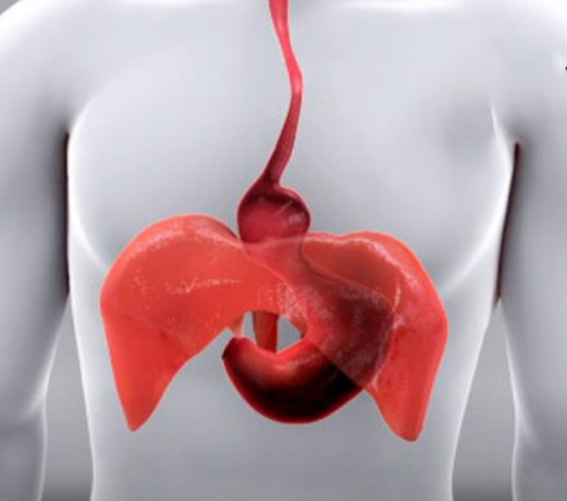hernia-hiatala-dr-bogdan-smeu