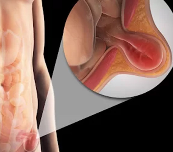 hernia-inghinala-bogdan-smeu