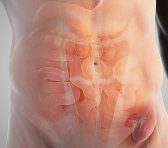 hernia-inghinala-unilaterala-bogdan-smeu