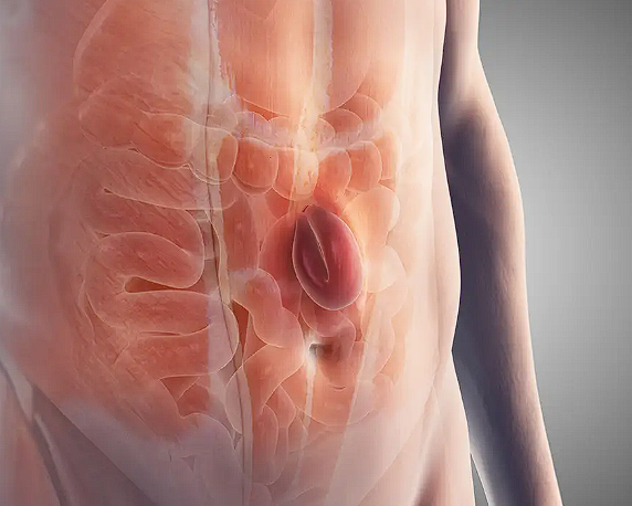 hernia ventrala