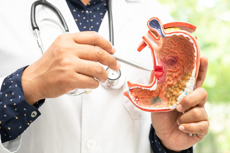 Stomach disease, doctor holding anatomy model for study diagnosi