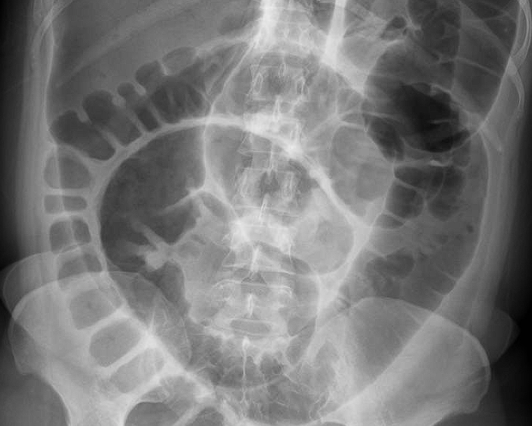 volvulus