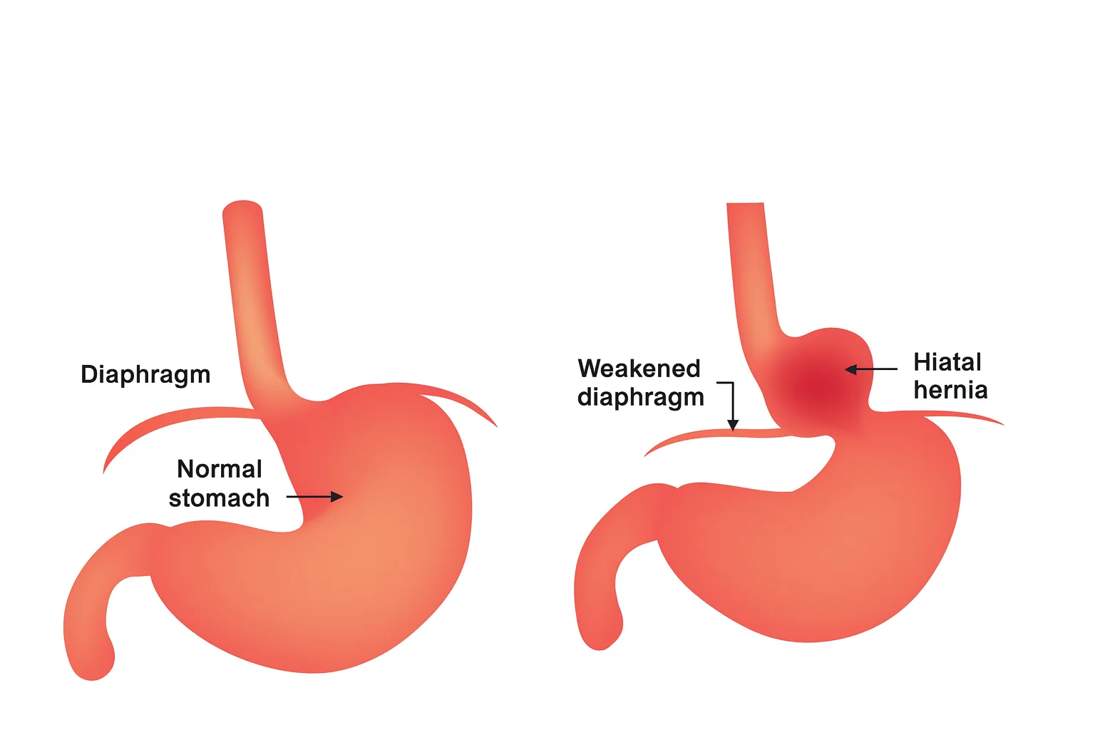 hernia_hiatala_explicatii