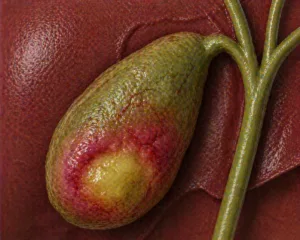 Ilustratie medicala abces pericolecistic cu colectie infectioasa in jurul colecistului fara elemente grafice suplimentare