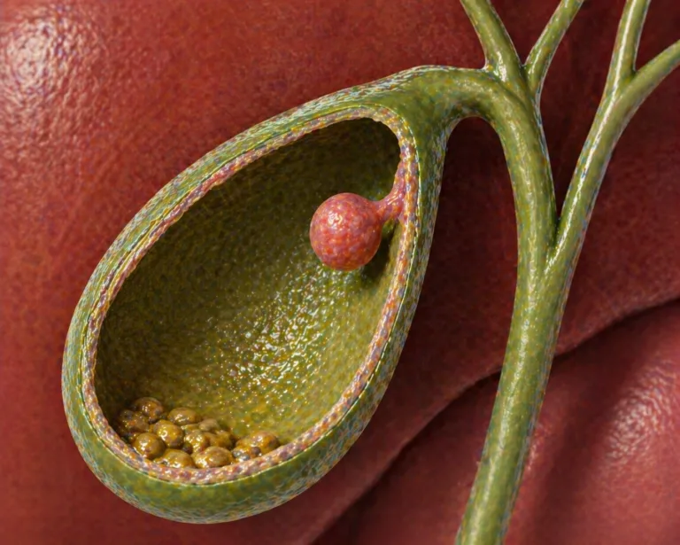 Ilustratie medicala adenomi la nivelul vezicii biliare pe peretele colecistului