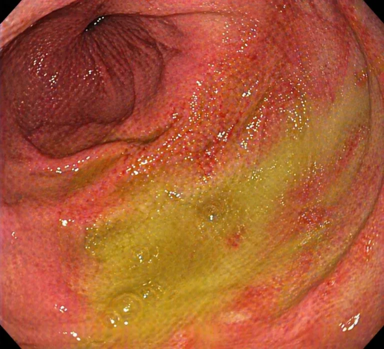 Imagine endoscopica cu reflux biliar in stomac sugestiv pentru gastrita biliara fara elemente grafice suplimentare