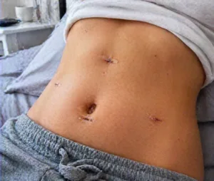 Incizii laparoscopice abdominale in curs de vindecare dupa operatia de fiere fara elemente grafice suplimentare