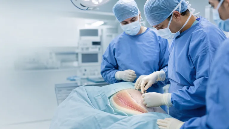 Echipă chirurgicală în timpul reconstrucției complexe a peretelui abdominal prin tehnica TAR