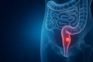 Cancerul de rect – primele simptome și de ce contează diagnosticul precoce