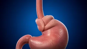 Ilustrație medicală pentru fundoplicatura Nissen