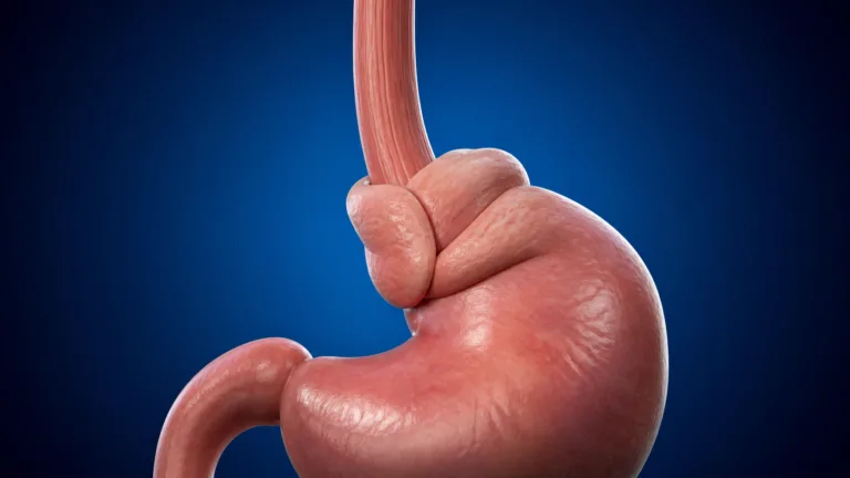 Ilustrație medicală pentru fundoplicatura Nissen