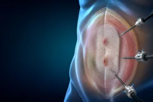 Cura laparoscopică combinată a herniei epigastrice și ombilicale prin procedeu IPOM Plus cu plasă Ventralight™ ST