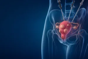 Histerectomia laparoscopică pentru leiomioame uterine multiple – când păstrarea uterului nu mai este răspunsul corect