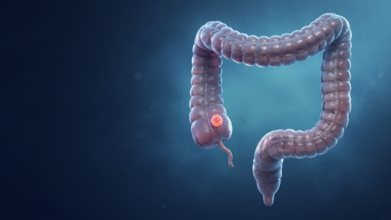 Ilustrație medicală a colonului pentru articol despre cancer colorectal