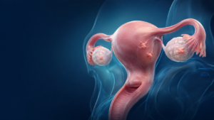 Ilustrație medicală pentru endometrioză și evaluare chirurgicală